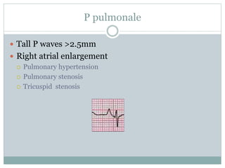 P pulmonale
 Tall P waves >2.5mm
 Right atrial enlargement
 Pulmonary hypertension
 Pulmonary stenosis
 Tricuspid stenosis
 