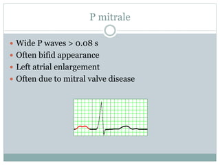 P mitrale
 Wide P waves > 0.08 s
 Often bifid appearance
 Left atrial enlargement
 Often due to mitral valve disease
 
