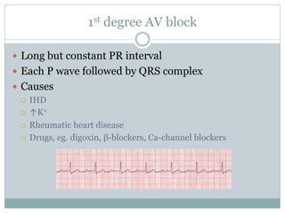 1st degree AV block
 Long but constant PR interval
 Each P wave followed by QRS complex
 Causes
 IHD
 ↑K+
 Rheumatic heart disease
 Drugs, eg. digoxin, β-blockers, Ca-channel blockers
 