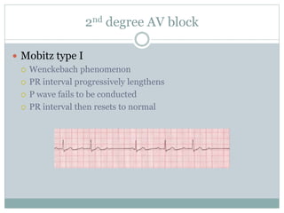 2nd degree AV block
 Mobitz type I
 Wenckebach phenomenon
 PR interval progressively lengthens
 P wave fails to be conducted
 PR interval then resets to normal
 