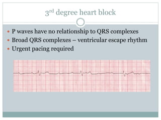 3rd degree heart block
 P waves have no relationship to QRS complexes
 Broad QRS complexes – ventricular escape rhythm
 Urgent pacing required
 