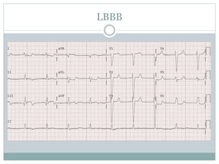 LBBB
 