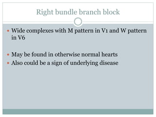 Right bundle branch block
 Wide complexes with M pattern in V1 and W pattern
in V6
 May be found in otherwise normal hearts
 Also could be a sign of underlying disease
 