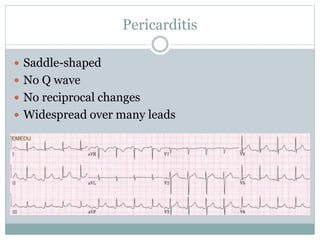 Pericarditis
 Saddle-shaped
 No Q wave
 No reciprocal changes
 Widespread over many leads
 