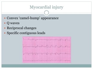 Myocardial injury
 Convex ‘camel-hump’ appearance
 Q waves
 Reciprocal changes
 Specific contiguous leads
 