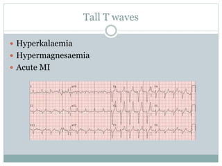 Tall T waves
 Hyperkalaemia
 Hypermagnesaemia
 Acute MI
 