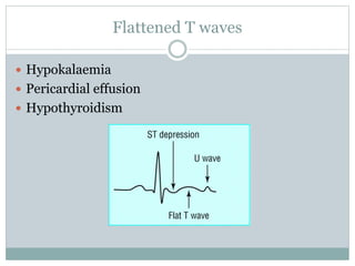 Flattened T waves
 Hypokalaemia
 Pericardial effusion
 Hypothyroidism
 
