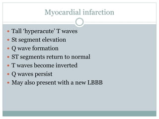 Myocardial infarction
 Tall ‘hyperacute’ T waves
 St segment elevation
 Q wave formation
 ST segments return to normal
 T waves become inverted
 Q waves persist
 May also present with a new LBBB
 