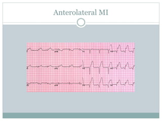Anterolateral MI
 