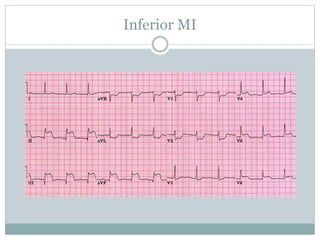 Inferior MI
 