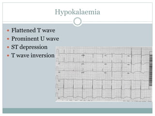 Hypokalaemia
 Flattened T wave
 Prominent U wave
 ST depression
 T wave inversion
 