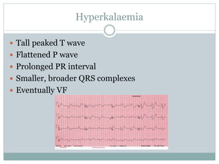 Hyperkalaemia
 Tall peaked T wave
 Flattened P wave
 Prolonged PR interval
 Smaller, broader QRS complexes
 Eventually VF
 