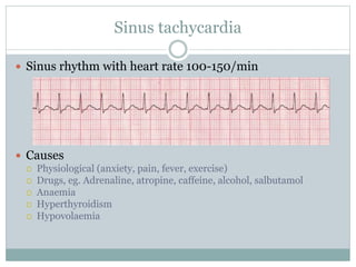 Sinus tachycardia
 Sinus rhythm with heart rate 100-150/min
 Causes
 Physiological (anxiety, pain, fever, exercise)
 Drugs, eg. Adrenaline, atropine, caffeine, alcohol, salbutamol
 Anaemia
 Hyperthyroidism
 Hypovolaemia
 
