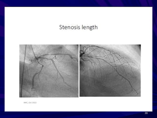 Interpretation of coronary angiogram | PPT