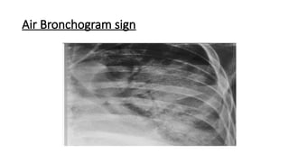 Interpretation of Chest X rays .pptx