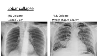 Rml Collapse Radiograph Interpretation of Chest X rays .pptx