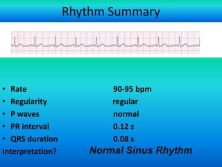 Rhythm Summary

• Rate
• Regularity
• P waves
• PR interval
• QRS duration
Interpretation?

90-95 bpm
regular
normal
0.12 s
0.08 s

Normal Sinus Rhythm

For more presentations
www.medicalppt.blogspot.com

 