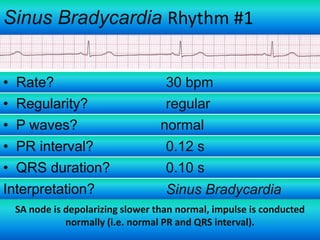 Sinus Bradycardia Rhythm #1
• Rate?
• Regularity?
• P waves?
• PR interval?
• QRS duration?
Interpretation?

30 bpm
regular
normal
0.12 s
0.10 s
Sinus Bradycardia

SA node is depolarizing slower than normal, impulse is conducted
normally (i.e. normal PR and QRS interval).

 