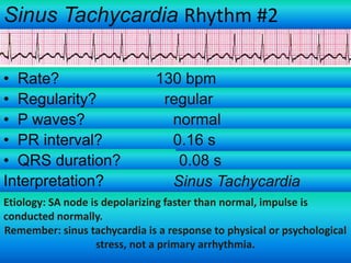 Sinus Tachycardia Rhythm #2
• Rate?
• Regularity?
• P waves?
• PR interval?
• QRS duration?
Interpretation?

130 bpm
regular
normal
0.16 s
0.08 s
Sinus Tachycardia

Etiology: SA node is depolarizing faster than normal, impulse is
conducted normally.
Remember: sinus tachycardia is a response to physical or psychological
stress, not a primary arrhythmia.

 
