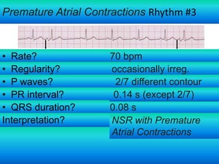 Premature Atrial Contractions Rhythm #3

• Rate?
• Regularity?
• P waves?
• PR interval?
• QRS duration?
Interpretation?

70 bpm
occasionally irreg.
2/7 different contour
0.14 s (except 2/7)
0.08 s
NSR with Premature
Atrial Contractions

 