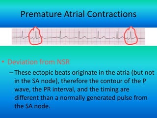 Premature Atrial Contractions

• Deviation from NSR
– These ectopic beats originate in the atria (but not
in the SA node), therefore the contour of the P
wave, the PR interval, and the timing are
different than a normally generated pulse from
the SA node.
For more presentations
www.medicalppt.blogspot.com

 