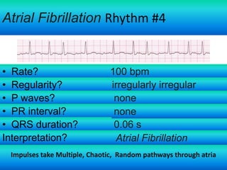 Atrial Fibrillation Rhythm #4

• Rate?
• Regularity?
• P waves?
• PR interval?
• QRS duration?
Interpretation?

100 bpm
irregularly irregular
none
none
0.06 s
Atrial Fibrillation

Impulses take Multiple, Chaotic, Random pathways through atria

 