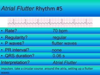 Atrial Flutter Rhythm #5

• Rate?
• Regularity?
• P waves?
• PR interval?
• QRS duration?
Interpretation?

70 bpm
regular
flutter waves
none
0.06 s
Atrial Flutter

Impulses take a circular course around the atria, setting up a flutter
waves

 
