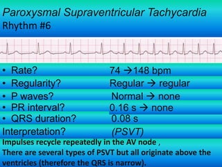 Paroxysmal Supraventricular Tachycardia
Rhythm #6

• Rate?
• Regularity?
• P waves?
• PR interval?
• QRS duration?
Interpretation?

74 148 bpm
Regular  regular
Normal  none
0.16 s  none
0.08 s
(PSVT)

Impulses recycle repeatedly in the AV node ,
There are several types of PSVT but all originate above the
ventricles (therefore the QRS is narrow).

 