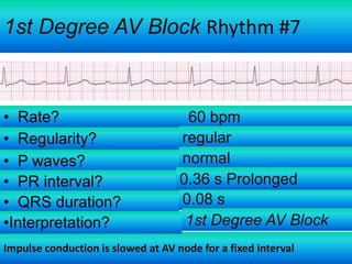 1st Degree AV Block Rhythm #7

• Rate?
• Regularity?
• P waves?
• PR interval?
• QRS duration?
•Interpretation?

60 bpm
regular
normal
0.36 s Prolonged
0.08 s
1st Degree AV Block

Impulse conduction is slowed at AV node for a fixed interval

 