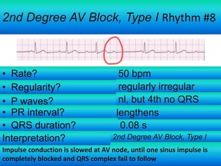 2nd Degree AV Block, Type I Rhythm #8

• Rate?
• Regularity?
• P waves?
• PR interval?
• QRS duration?
Interpretation?

50 bpm
regularly irregular
nl, but 4th no QRS
lengthens
0.08 s
2nd Degree AV Block, Type I

Impulse conduction is slowed at AV node, until one sinus impulse is
completely blocked and QRS complex fail to follow

 