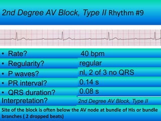 2nd Degree AV Block, Type II Rhythm #9

• Rate?
• Regularity?
• P waves?
• PR interval?
• QRS duration?
Interpretation?

40 bpm
regular
nl, 2 of 3 no QRS
0.14 s
0.08 s
2nd Degree AV Block, Type II

Site of the block is often below the AV node at bundle of His or bundle
branches ( 2 dropped beats)

 