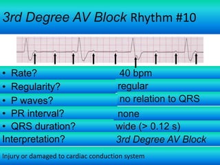 3rd Degree AV Block Rhythm #10

• Rate?
• Regularity?
• P waves?
• PR interval?
• QRS duration?
Interpretation?

40 bpm
regular
no relation to QRS
none
wide (> 0.12 s)
3rd Degree AV Block

Injury or damaged to cardiac conduction system

 