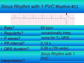 Sinus Rhythm with 1 PVC Rhythm #11

•
•
•
•
•

Rate?
Regularity?
P waves?
PR interval?
QRS duration?

Interpretation?

60 bpm
occasionally irreg.
none for 7th QRS
0.14 s
0.08 s (7th wide)
Sinus Rhythm with 1
PVC

For more presentations www.medicalppt.blogspot.com

 