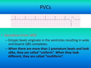 PVCs

• Deviation from NSR
– Ectopic beats originate in the ventricles resulting in wide
and bizarre QRS complexes.
– When there are more than 1 premature beats and look
alike, they are called “uniform”. When they look
different, they are called “multiform”.
For more presentations
www.medicalppt.blogspot.com

 