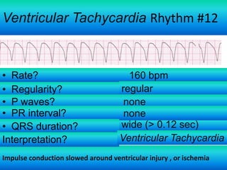 Ventricular Tachycardia Rhythm #12

• Rate?
• Regularity?
• P waves?
• PR interval?
• QRS duration?
Interpretation?

160 bpm
regular
none
none
wide (> 0.12 sec)
Ventricular Tachycardia

Impulse conduction slowed around ventricular injury , or ischemia

 