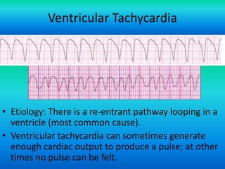 Ventricular Tachycardia

• Etiology: There is a re-entrant pathway looping in a
ventricle (most common cause).
• Ventricular tachycardia can sometimes generate
enough cardiac output to produce a pulse; at other
times no pulse can be felt.
For more presentations
www.medicalppt.blogspot.com

 