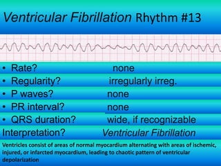 Ventricular Fibrillation Rhythm #13

• Rate?
• Regularity?
• P waves?
• PR interval?
• QRS duration?
Interpretation?

none
irregularly irreg.
none
none
wide, if recognizable
Ventricular Fibrillation

Ventricles consist of areas of normal myocardium alternating with areas of ischemic,
injured, or infarcted myocardium, leading to chaotic pattern of ventricular
depolarization

 
