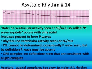 Asystole Rhythm # 14

•Rate: no ventricular activity seen or ≤6/min; so-called “Pwave asystole” occurs with only atrial
impulses present to form P waves
• Rhythm: no ventricular activity seen; or ≤6/min
• PR: cannot be determined; occasionally P wave seen, but
by definition R wave must be absent
• QRS complex: no deflections seen that are consistent with
a QRS complex
Asystole: agonal complexes too slow to make this rhythm

 
