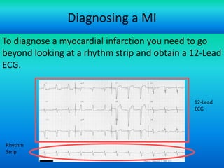 Diagnosing a MI
To diagnose a myocardial infarction you need to go
beyond looking at a rhythm strip and obtain a 12-Lead
ECG.

12-Lead
ECG

Rhythm
Strip
For more presentations
www.medicalppt.blogspot.com

 