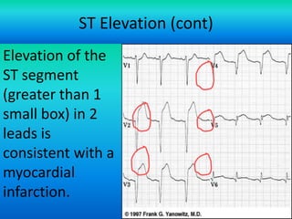 ST Elevation (cont)
Elevation of the
ST segment
(greater than 1
small box) in 2
leads is
consistent with a
myocardial
infarction.
For more presentations
www.medicalppt.blogspot.com

 