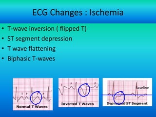 ECG Changes : Ischemia
•
•
•
•

T-wave inversion ( flipped T)
ST segment depression
T wave flattening
Biphasic T-waves

Baseline


2004 Anna Story

45

 
