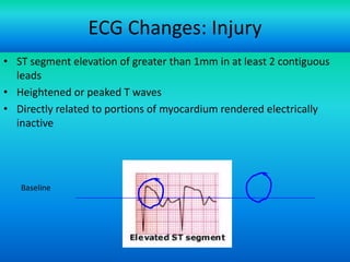 ECG Changes: Injury
• ST segment elevation of greater than 1mm in at least 2 contiguous
leads
• Heightened or peaked T waves
• Directly related to portions of myocardium rendered electrically
inactive

Baseline


2004 Anna Story

46

 