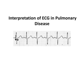 Interpretation of ECG in Pulmonary
Disease
 