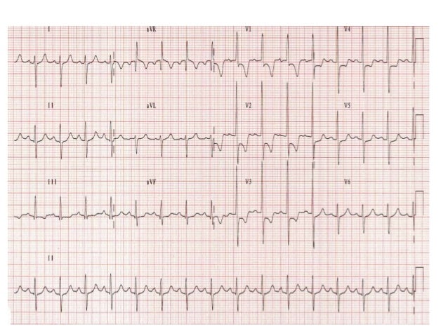 Interpretation of ecg_in_pulmonary_disease