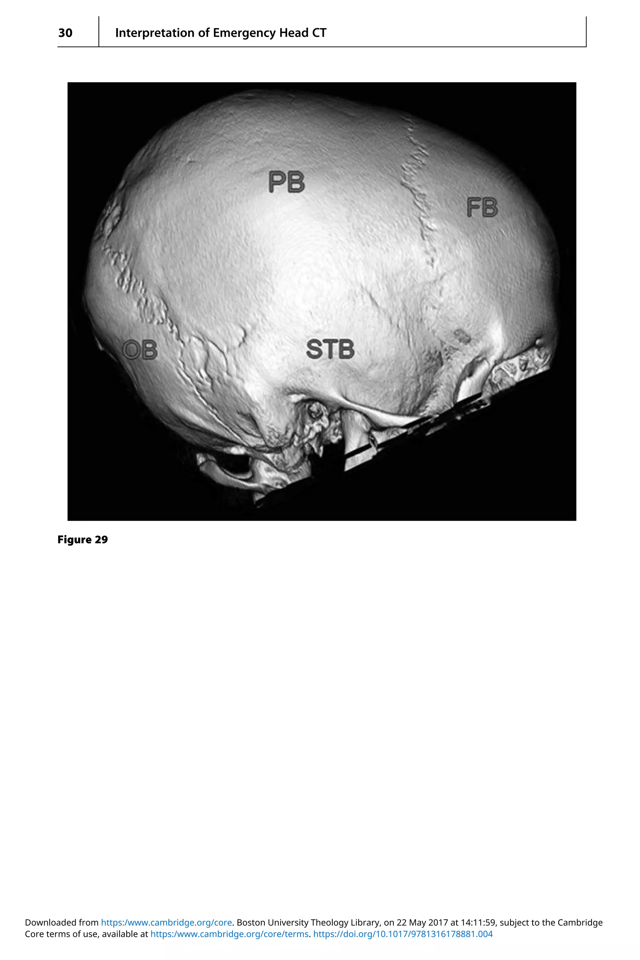 Interpretation of emergency head ct | PDF