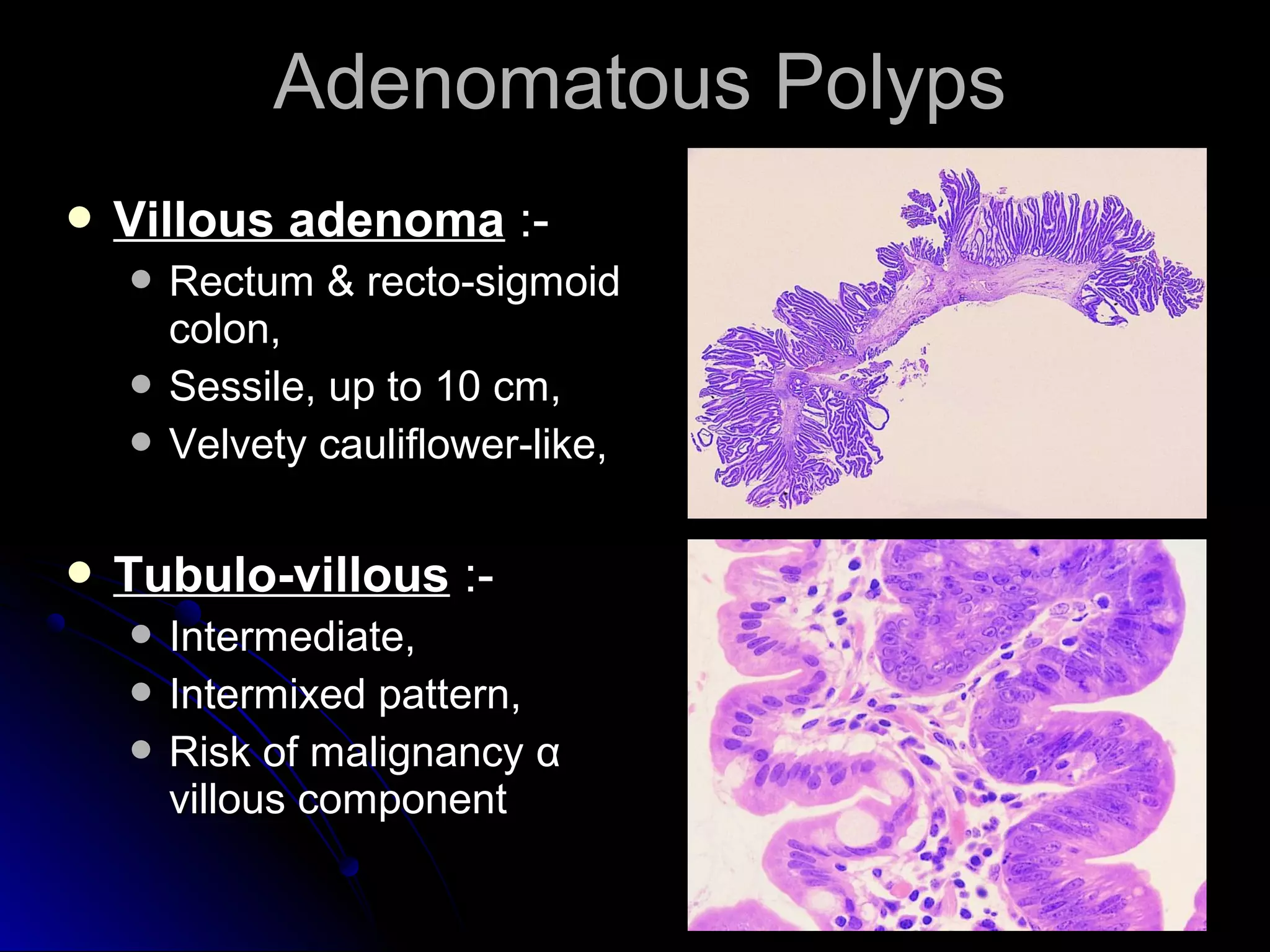  Villous adenomaVillous adenoma :-:-
 Rectum & recto-sigmoidRectum & recto-sigmoid
colon,colon,
 Sessile, up to 10 cm,Sessile, up to 10 cm,
 Velvety cauliflower-like,Velvety cauliflower-like,
 Tubulo-villousTubulo-villous :-:-
 Intermediate,Intermediate,
 Intermixed pattern,Intermixed pattern,
 Risk of malignancyRisk of malignancy αα
villous componentvillous component
Adenomatous PolypsAdenomatous Polyps
 