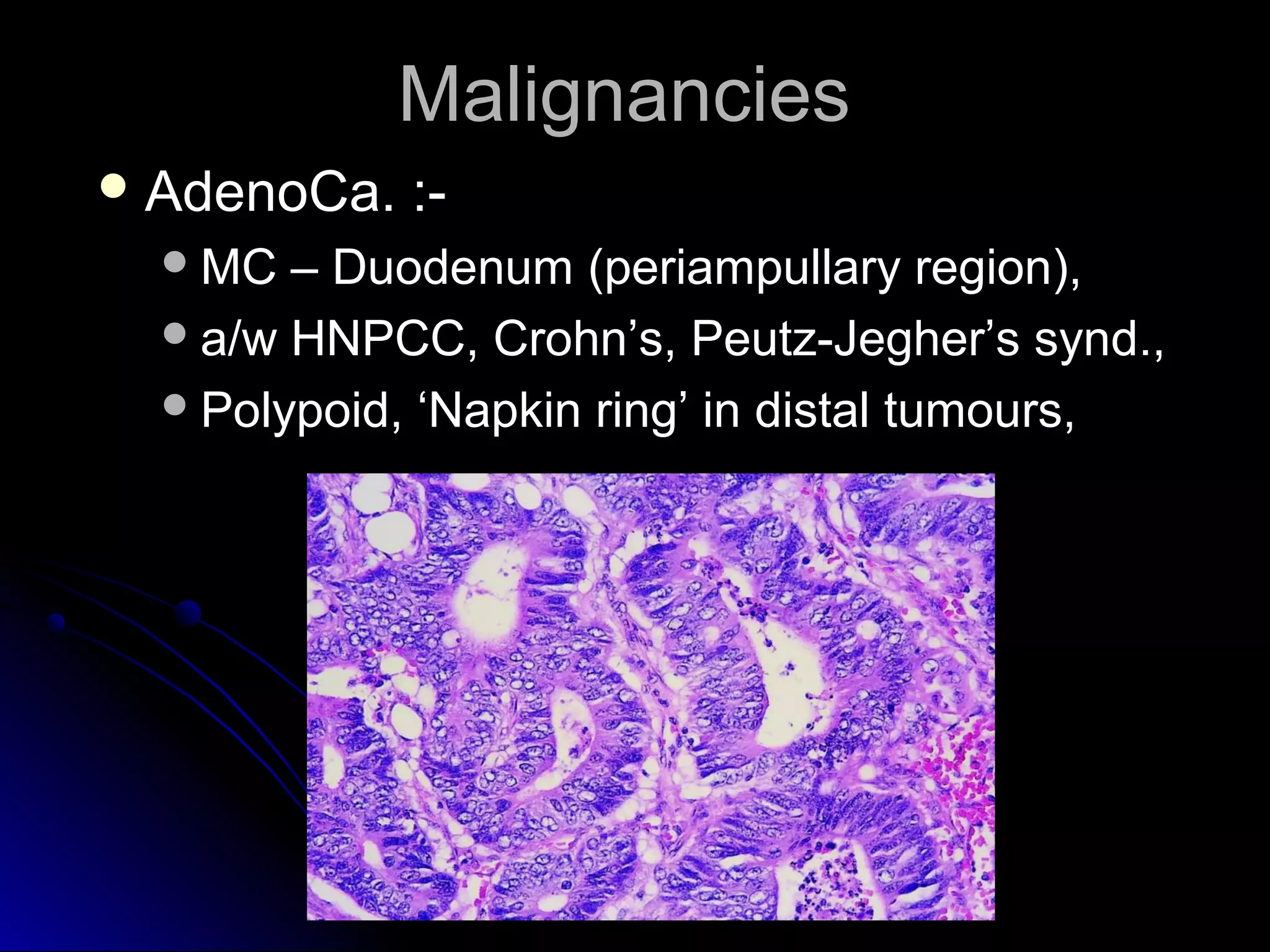 MalignanciesMalignancies
 AdenoCa. :-AdenoCa. :-
MC – Duodenum (periampullary region),MC – Duodenum (periampullary region),
a/w HNPCC, Crohn’s, Peutz-Jegher’s synd.,a/w HNPCC, Crohn’s, Peutz-Jegher’s synd.,
Polypoid, ‘Napkin ring’ in distal tumours,Polypoid, ‘Napkin ring’ in distal tumours,
 