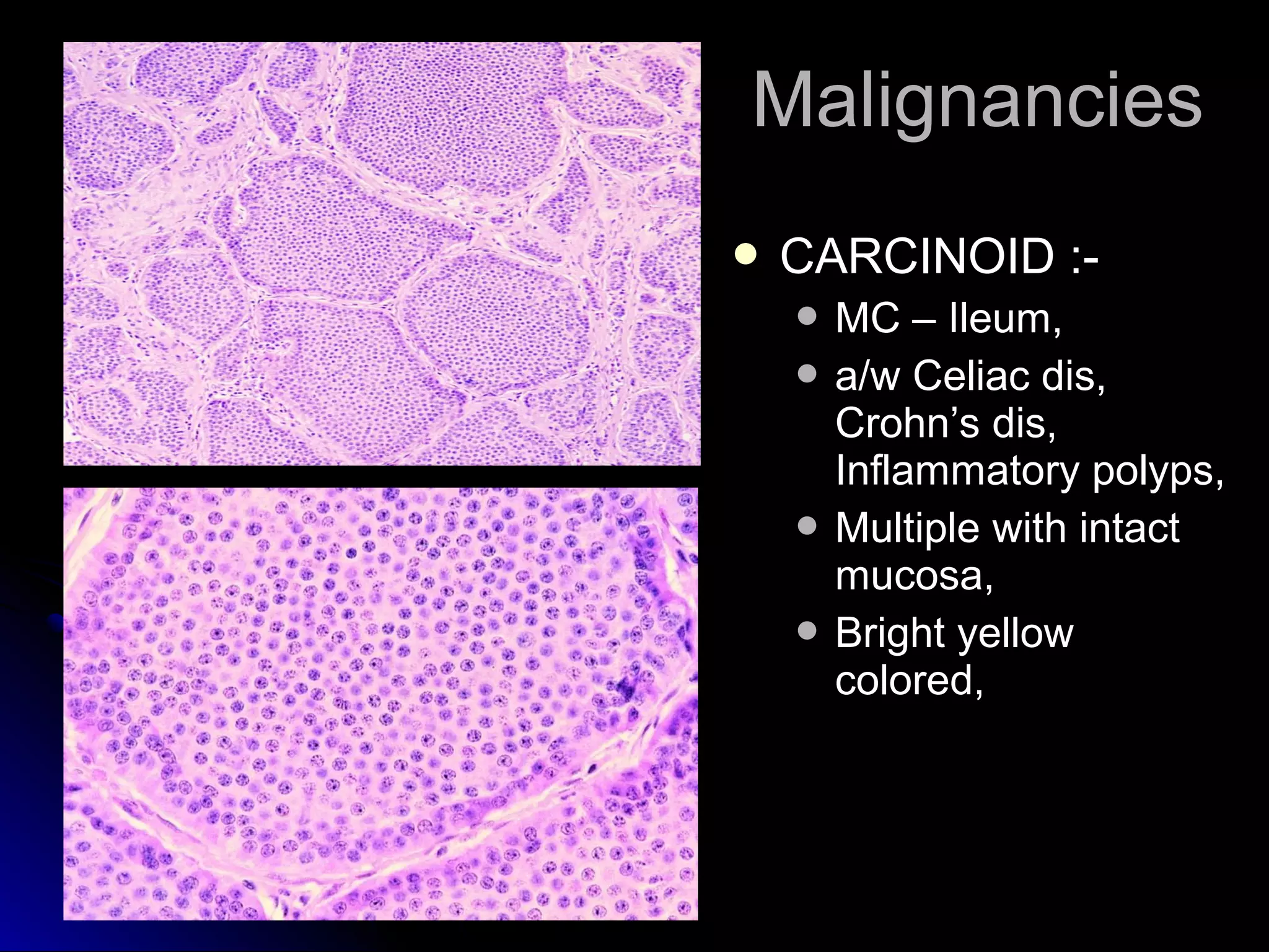  CARCINOID :-CARCINOID :-
 MC – Ileum,MC – Ileum,
 a/w Celiac dis,a/w Celiac dis,
Crohn’s dis,Crohn’s dis,
Inflammatory polyps,Inflammatory polyps,
 Multiple with intactMultiple with intact
mucosa,mucosa,
 Bright yellowBright yellow
colored,colored,
MalignanciesMalignancies
 