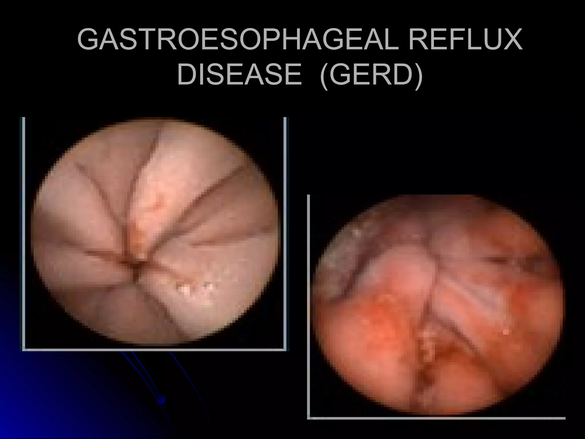 GASTROESOPHAGEAL REFLUXGASTROESOPHAGEAL REFLUX
DISEASE (GERD)DISEASE (GERD)
 