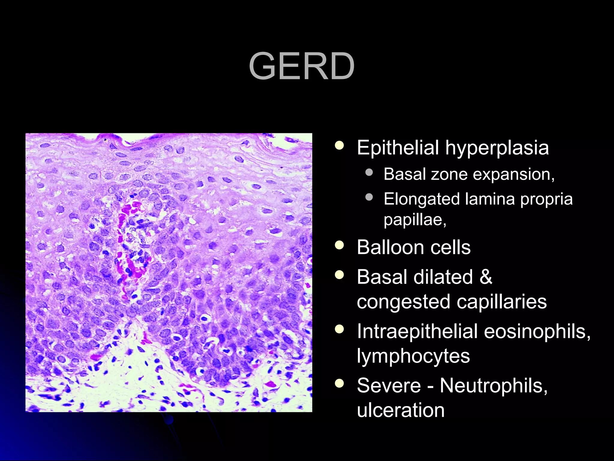 GERDGERD
 Epithelial hyperplasiaEpithelial hyperplasia
 Basal zone expansion,Basal zone expansion,
 Elongated lamina propriaElongated lamina propria
papillae,papillae,
 Balloon cellsBalloon cells
 Basal dilated &Basal dilated &
congested capillariescongested capillaries
 Intraepithelial eosinophils,Intraepithelial eosinophils,
lymphocyteslymphocytes
 Severe - Neutrophils,Severe - Neutrophils,
ulcerationulceration
 